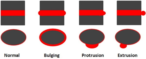 Bulging Discs | Protruding Discs | Extruding Discs